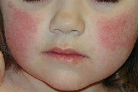 Rash on Face