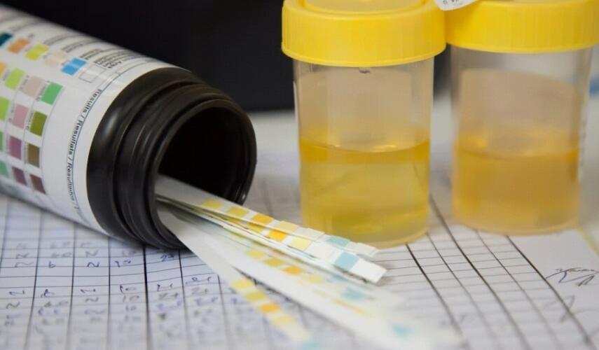 Ketones in Urine: Test, Symptoms, Causes and Treatments