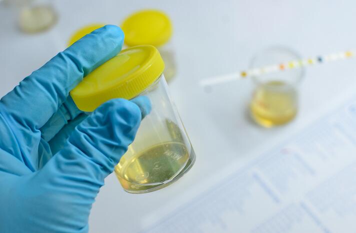 Urobilinogen in Urine: High, Low, Causes and Treatments
