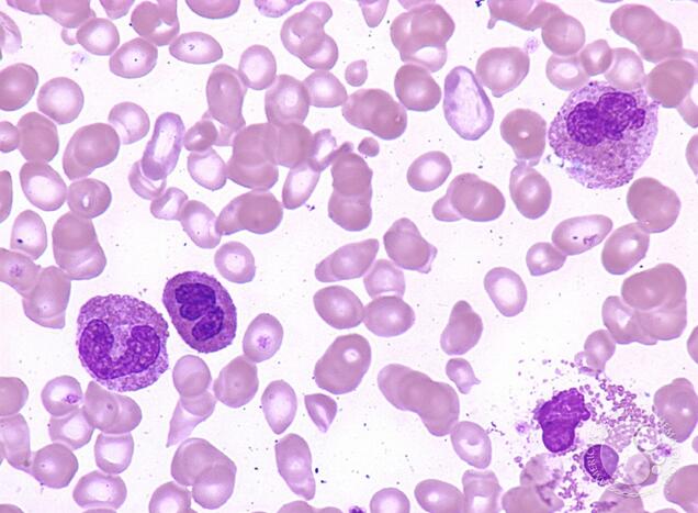 Eosinophils: Definition, Low, High Count and Causes