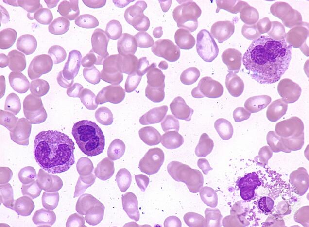 What is eosinophilia