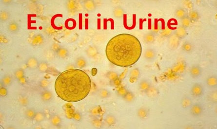 E. Coli in Urine