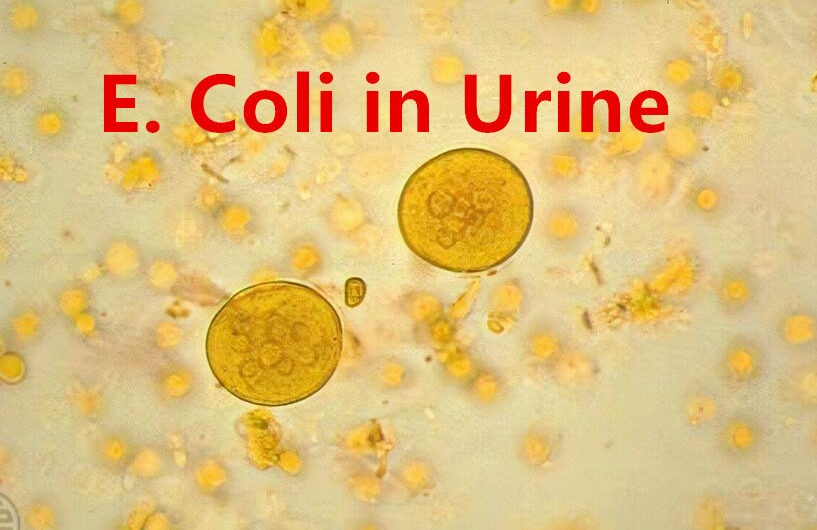 E. Coli in Urine: Meaning,Causes and Treatment