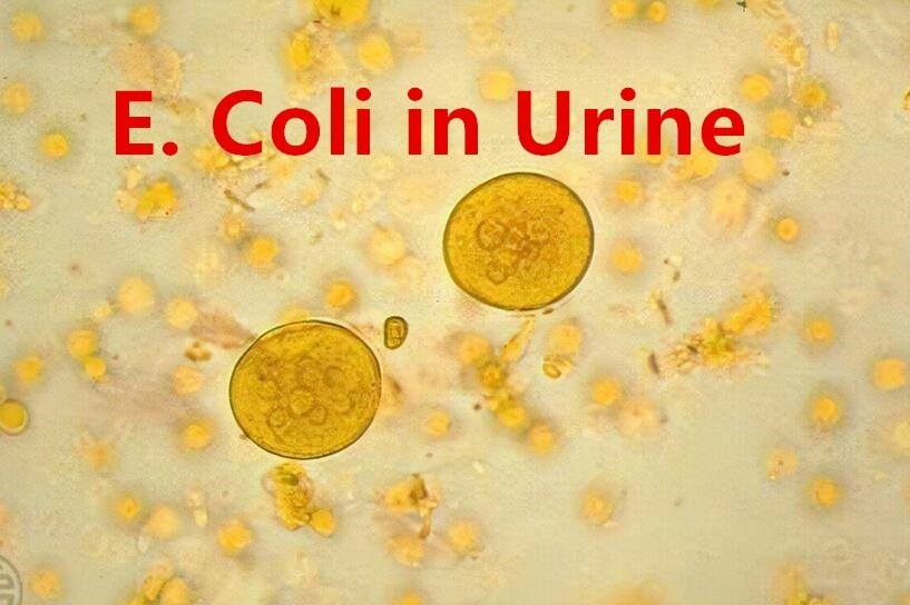 E. Coli in Urine