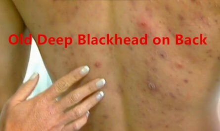 Old Deep Blackhead on Back