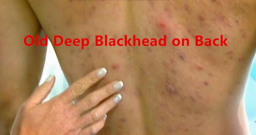 Infected Blackhead on Back for Years: Causes and Treatment