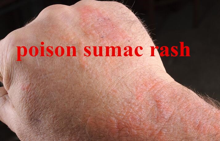 poison sumac rash