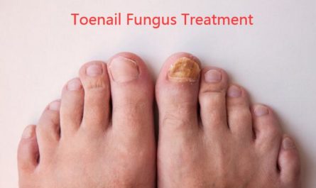 Toenail Fungus Treatment