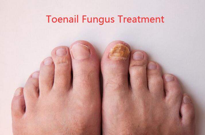 Toenail Fungus Treatment:15 Remedies that Actually Work