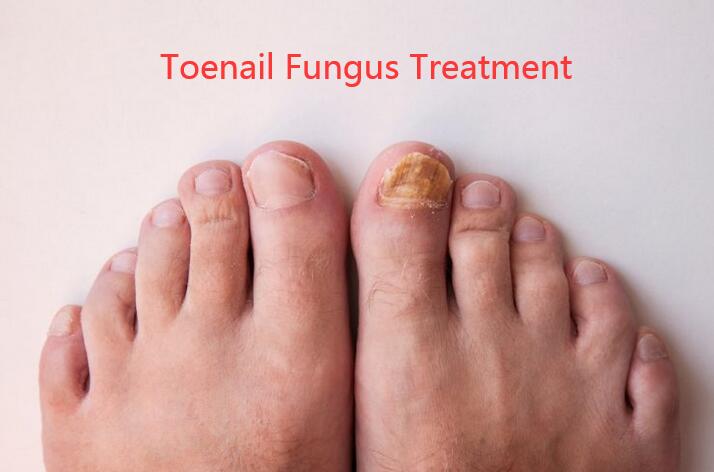 Toenail Fungus Treatment