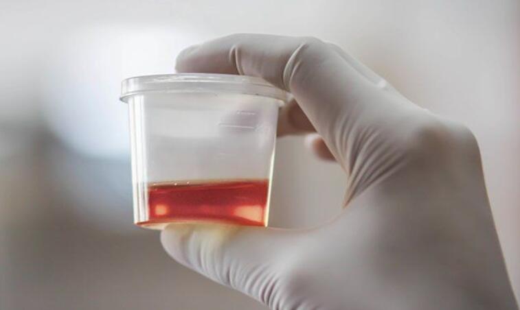 e coli in urine treatment