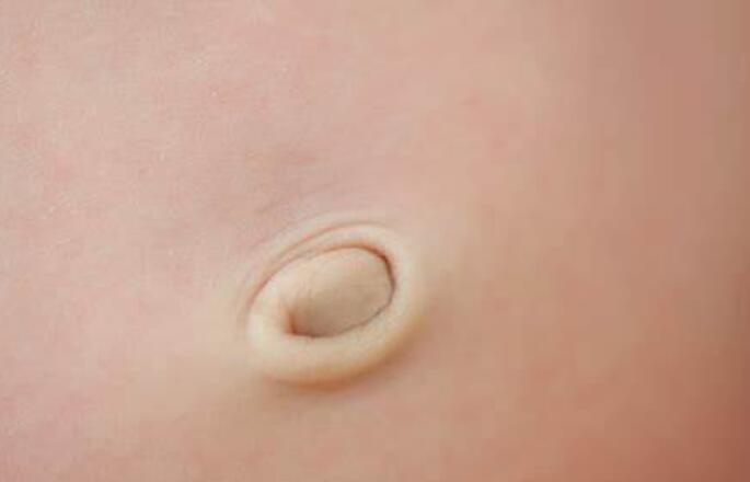 Belly Button Herniaumbilical Herniacausesandtreatment 