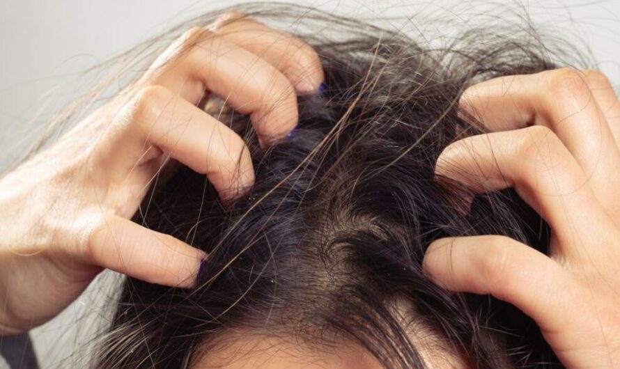 Dry and Itchy Scalp:10 Common Causes with Treatment