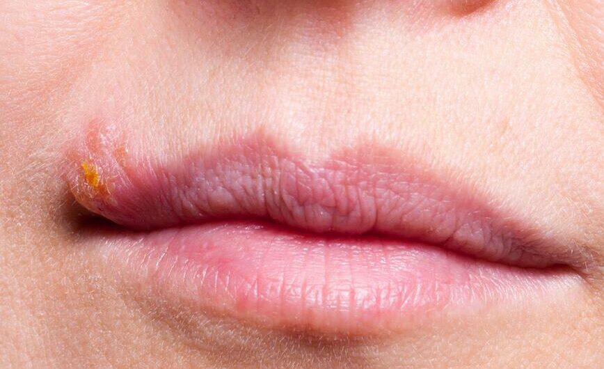 Pimple on Lip: Causes, Treatment, and Prevention