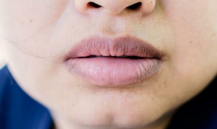How to Get Rid of Black Spots on Lips