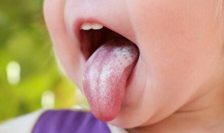 White Spots on Tongue