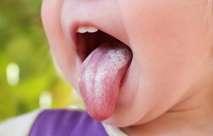 White Spots on Tongue