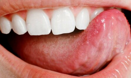 Ulcers on the Tongue