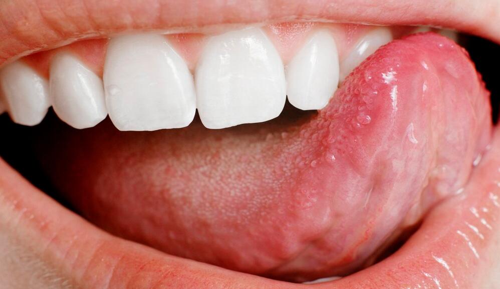 Ulcers on the Tongue