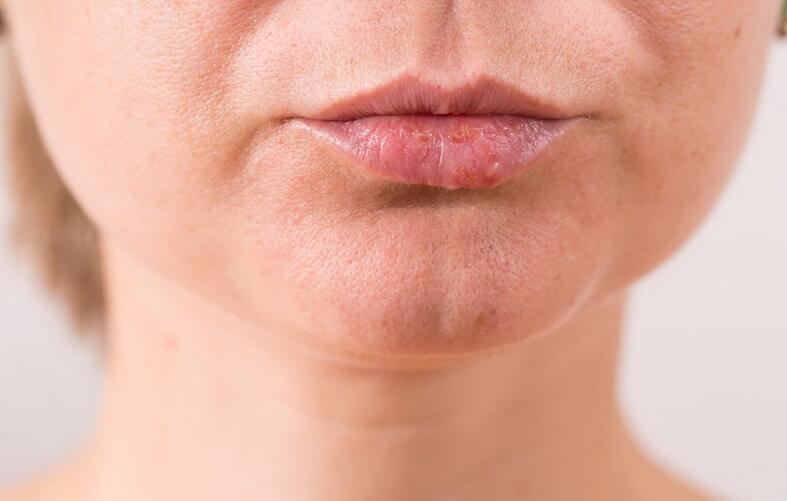 White Spots on Lips: 14 Causes and Treatments