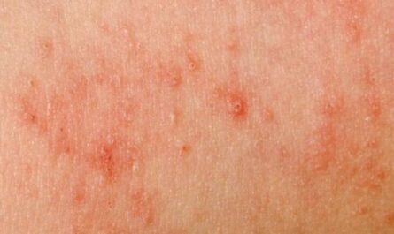 Yeast Infection on Skin