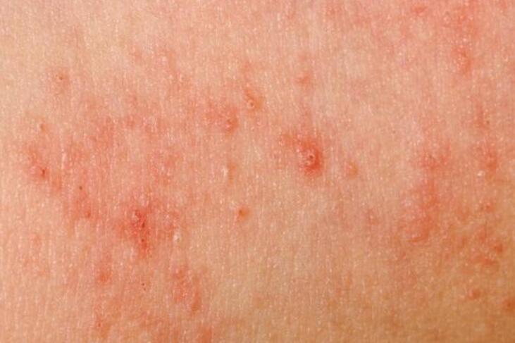 Yeast Infection on Skin