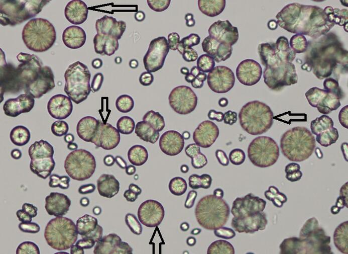 Calcium Oxalate Crystals in Urine