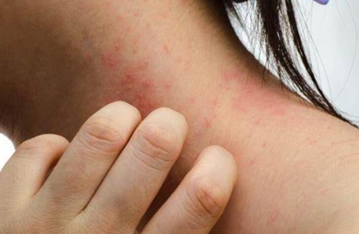 Rash on Neck and Face: Causes,Types and Treatments