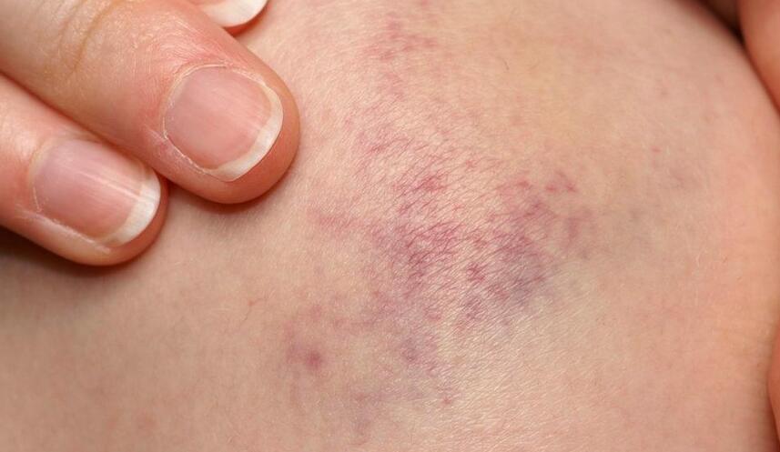 Reasons Why Your Bruises Won't Go Away