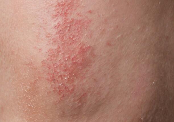 what is Eczema