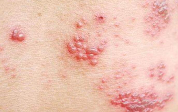 How to Identify Different Types of Skin Rashes