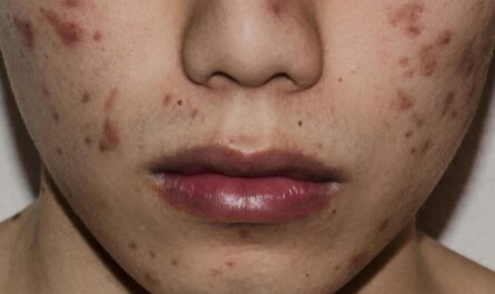 Break Out with Pimples Every Few Days then Go Away