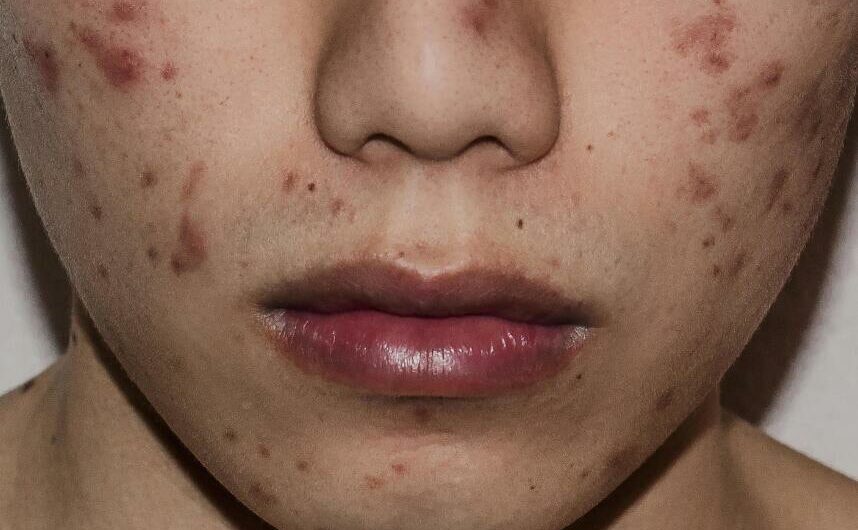 Break Out with Pimples Every Few Days then Go Away