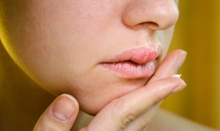 Natural Remedies to Get Rid of Swollen Lips