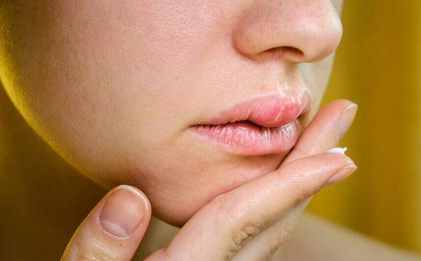 14 Natural Remedies to Get Rid of Swollen Lips