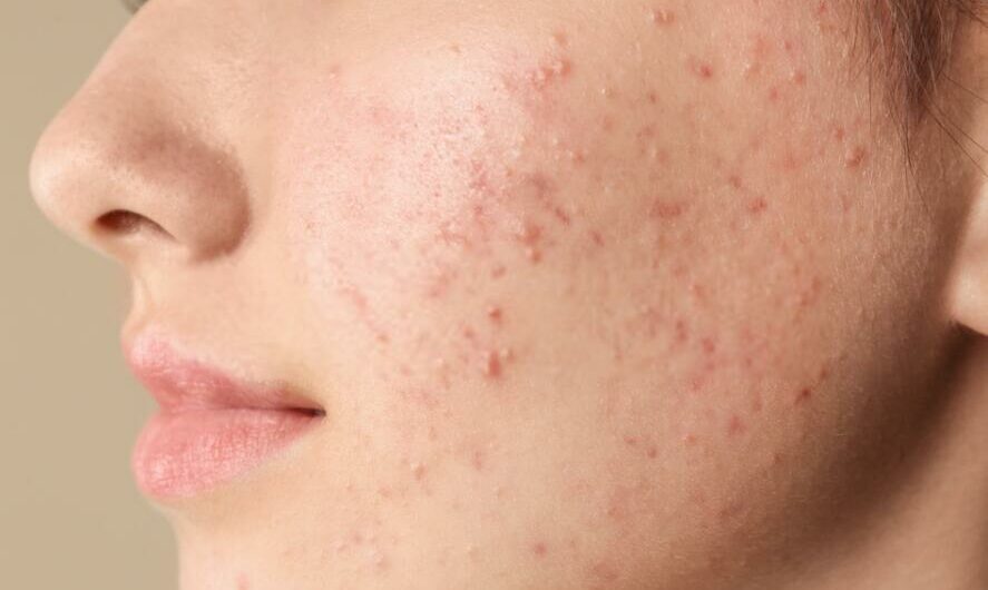 Adult Acne on Cheeks:10 Causes with Natural Remedies