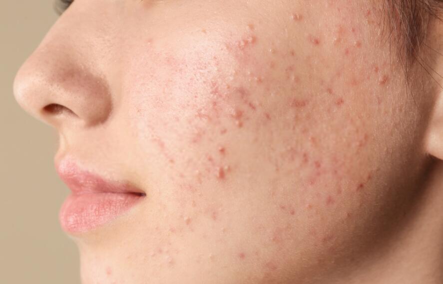 Adult Acne on the Cheeks