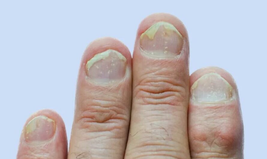 16 Natural Treatments For Psoriasis of the Nails