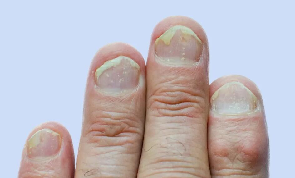 Psoriasis of the Nails