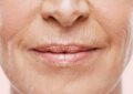 Treatments for Wrinkles Above the Lips