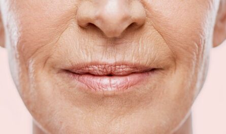 Treatments for Wrinkles Above the Lips