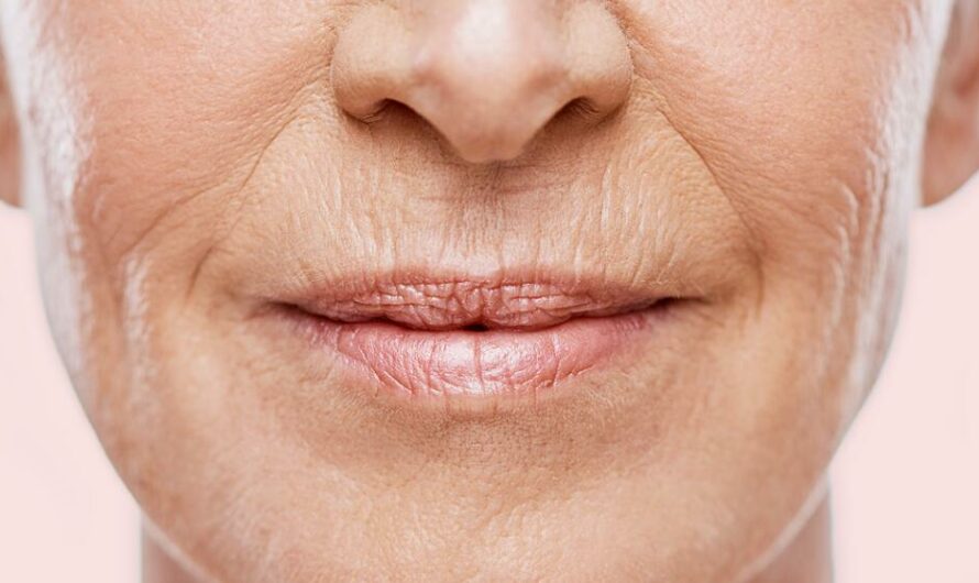 14 Best Treatments for Wrinkles Above the Lips