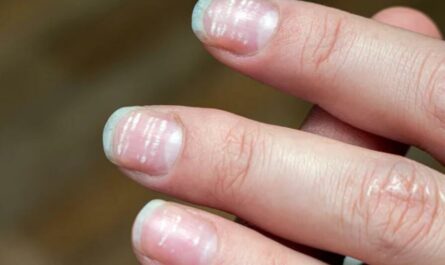 White Fingernails and Liver Disease