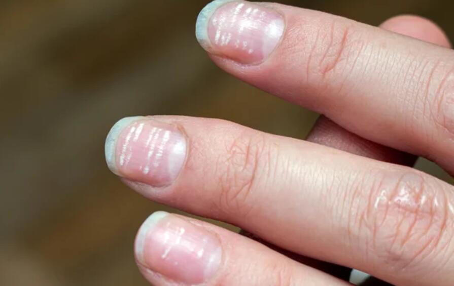 White Fingernails and Liver Disease