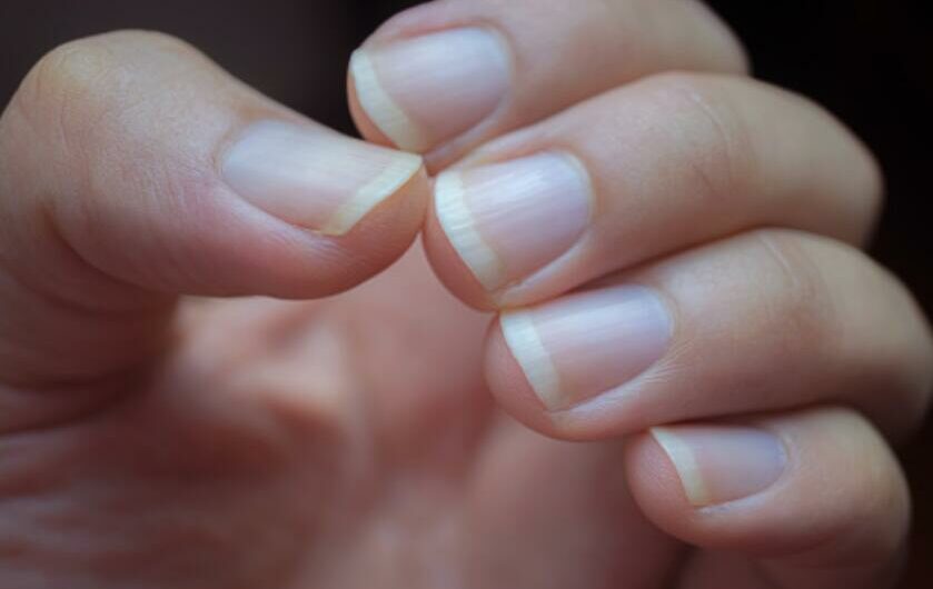 12 Common Causes of White Spots on Nails