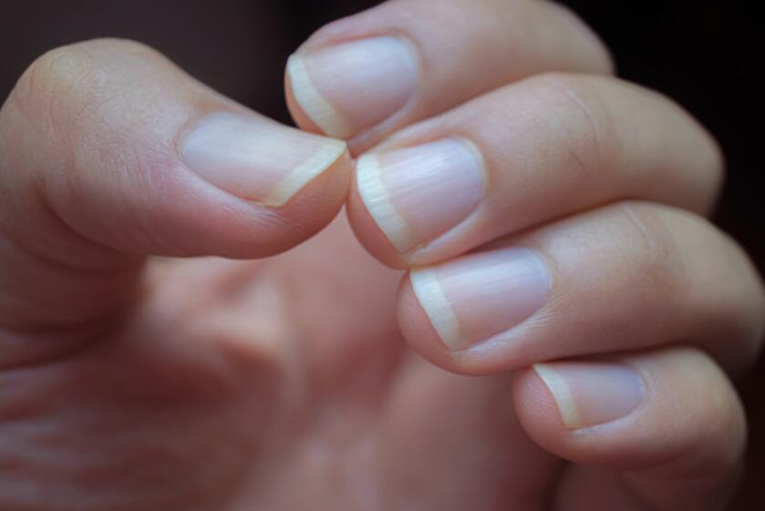White Spots on Nails