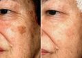 How to Remove Age Spots on Face