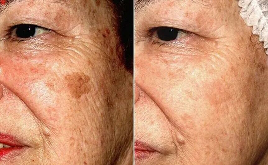 How to Remove Age Spots on Face: 14 Easy Ways