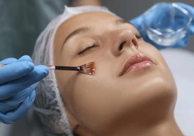 Chemical peels