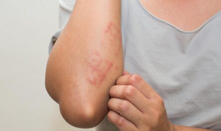 Natural Remedies for Eczema
